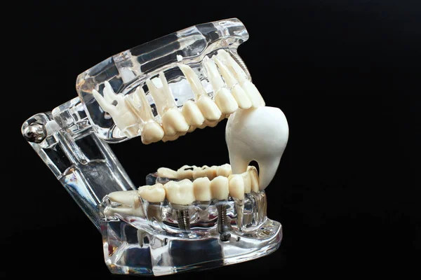Dental Jaw Model Black Background Transparent Invisible Dental Aligners Braces — Stock Photo, Image