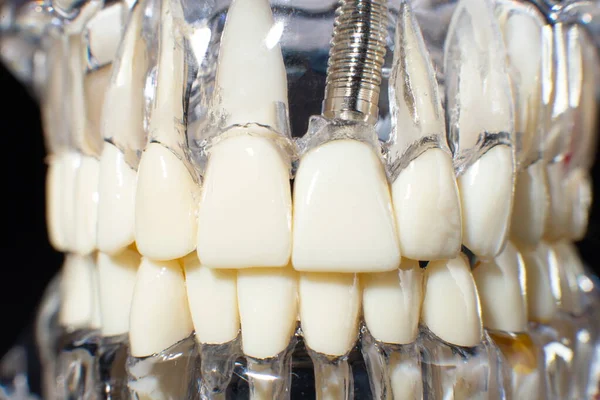 下颌骨模型覆盖黑色背景 牙科医生假牙 牙根特写 — 图库照片