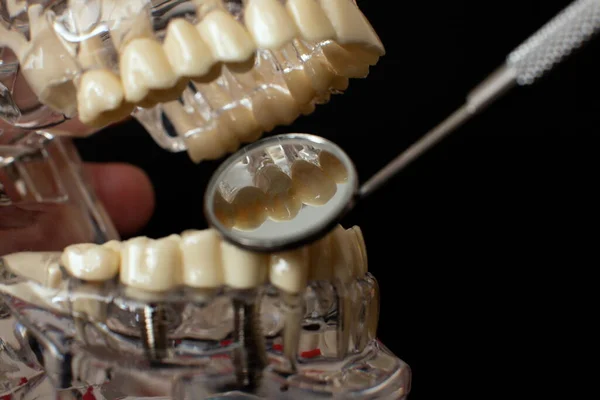 牙科医生假牙 根部特写 研究牙病概念 — 图库照片