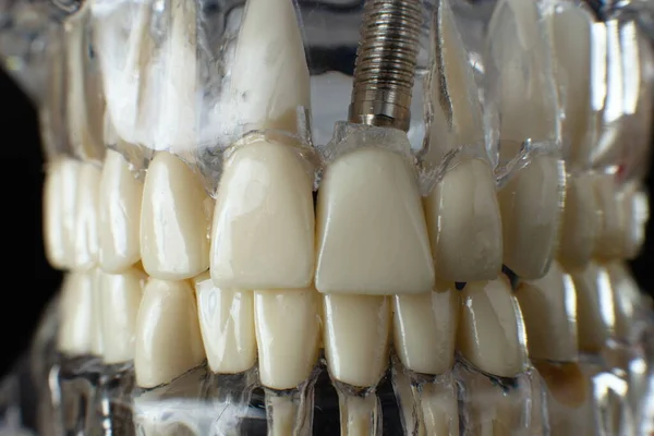 Modello Mascella Dentale Sfondo Nero Denti Protesici Dentisti Gengive Radici — Foto Stock