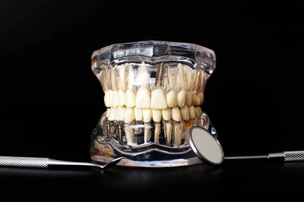 Dental Jaw Model Black Background Dentist Dental Prosthetic Teeth Gums — Stock Photo, Image