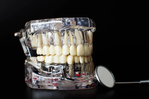下颌骨模型覆盖黑色背景 牙科医生假牙 牙根特写 — 图库照片