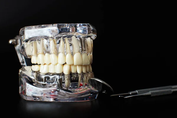 Model Szczęki Dentystycznej Czarnym Tle Dentysta Protezy Zębów Dziąsła Korzenie — Zdjęcie stockowe