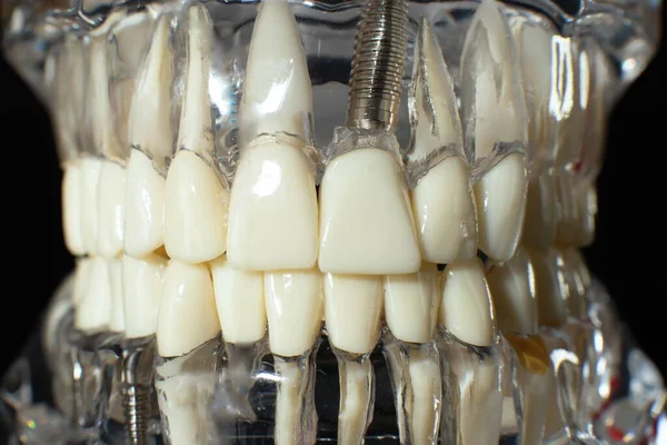 Modello Mascella Dentale Sfondo Nero Allineatori Dentali Invisibili Trasparenti Bretelle — Foto Stock