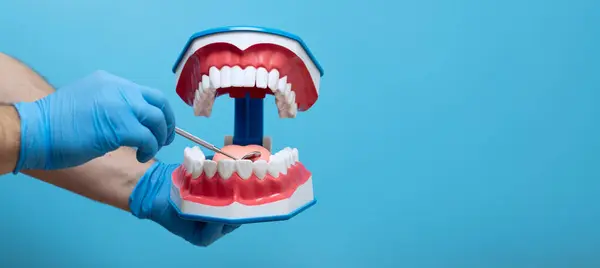 インプラント 歯垢とエナメルを示す手歯科歯の指導モデルでは — ストック写真