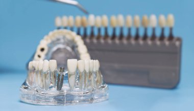 Dental implant model with shade guide selection