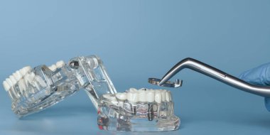 Diş implantı modeli ve cerrahi