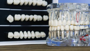 Diş implantı modeli ve arka planda diş setleri