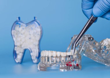 Diş kaplamasını şeffaf çene modeline yerleştirmek için cımbız kullanan eldivenli el, arka planda yedek diş kabı ile.