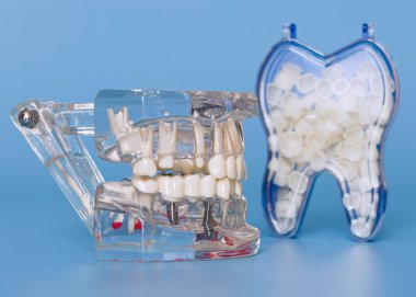 Diş kaplamalarıyla dolu diş şeklindeki bir konteynırın yanına yerleştirilmiş implantları ve dişleri gösteren şeffaf bir diş modelinin yan görünümü.