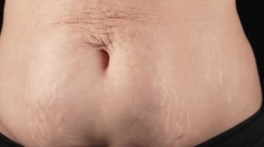 Hamilelikten sonra karnında gerilme izleri olan bir kadın. Doğal vücut dokusu. Anne karnında ağır kırışıklıklar, doğumdan sonra cilt gevşemesi. Sağlık hizmetleri, rehabilitasyon, vücut pozitifliği, kabullenme. 4k görüntü