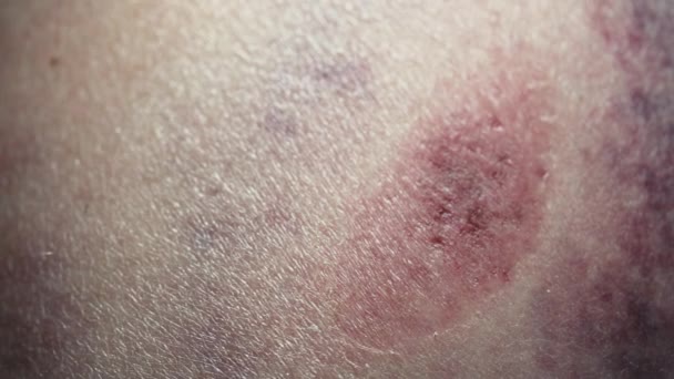 Velký Podlitinový Hematom Zasažení Lidské Kůže Kongesce Makro Zdravotní Zranění — Stock video