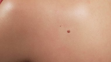 İnsan papilloma virüsü. Dişi sırtında nevüsler var. İnsan derisinde Papiloma neoplazmasının doğum izi, yakın plan büyümesi. Sağlık hizmeti kavramı.