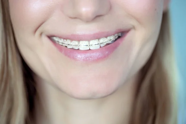 Närbild Foto Kvinna Med Trevligt Leende Och Keramiska Hängslen Tänderna — Stockfoto