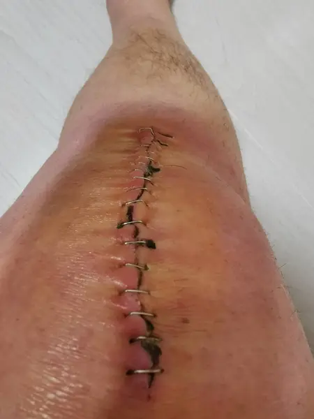 cut in the skin with staples from an operation