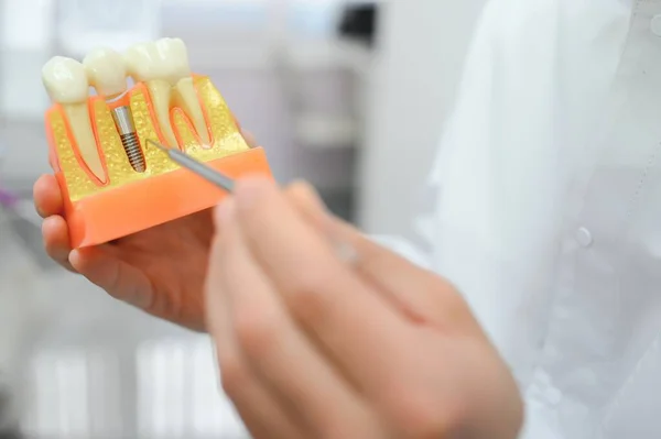 Doutor Mostra Uma Amostra Dente Plástico Modelo Diferentes Métodos Tratamento — Fotografia de Stock