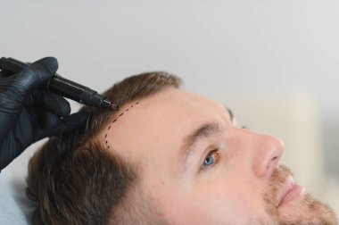 Estetik tıp. Doktor trichologist, müşterinin kafasındaki kellik bölgesini bir işaretle özetliyor. Alopecia ve mezoterapi kavramı..