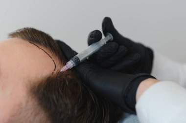 Adam kuaförde kuaförlük yapıyor, mezoterapi seansı yapıyor. Kadın terapist koruyucu eldiven verip şırınga yapıyor..