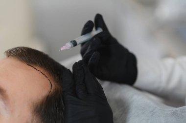 Yakışıklı bir adamın kuaförde saç bakımına gidişinin yan görüntüsü. Adam estetik kliniğinde mezoterapi görüyor, terapist eldiven takıyor kafa derisine iğne yapıyor, yakın çekim yapıyor.