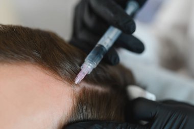 Saç için mezoterapi. Çekici bir adam kafasından iğne vuruluyor. Güzellik salonunda mezoterapi gören bir adam, şırıngalı koruyucu eldivenli bir terapist.,