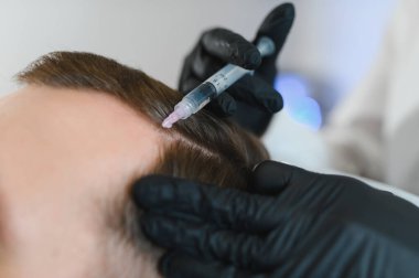 Yakışıklı bir adamın kuaförde saç bakımına gidişinin yan görüntüsü. Adam estetik kliniğinde mezoterapi görüyor, terapist eldiven takıyor kafa derisine iğne yapıyor, yakın çekim yapıyor.