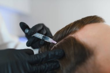 Saç için mezoterapi. Çekici bir adam kafasından iğne vuruluyor. Güzellik salonunda mezoterapi gören bir adam, şırıngalı koruyucu eldivenli bir terapist.,