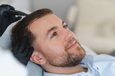 Yakışıklı bir adamın kuaförde saç bakımına gidişinin yan görüntüsü. Adam estetik kliniğinde mezoterapi görüyor, terapist eldiven takıyor kafa derisine iğne yapıyor, yakın çekim yapıyor.