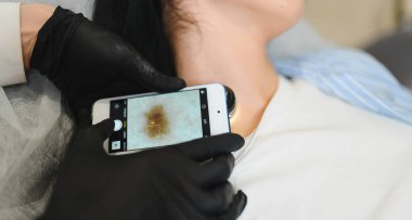 Doktor doğum lekeleri ve ben hastalarını inceliyor. Doğum lekeleri ve benler incelenir. Doktor hastanın benini inceler..