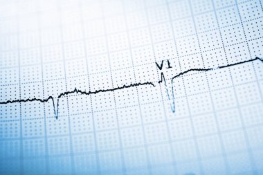 Elektrokardiyogram insan kalbinin nabzını gösteriyor.