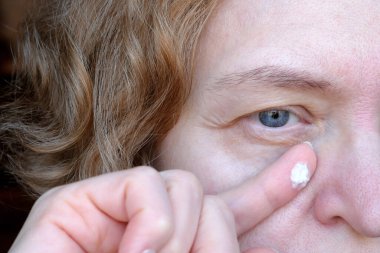 middle aged female's eye with drooping eyelid with cream cosmetic drop in finger. Ptosis is a drooping of the upper eyelid, lazy eye. Cosmetology and facial concept, first wrinkles, closeup clipart