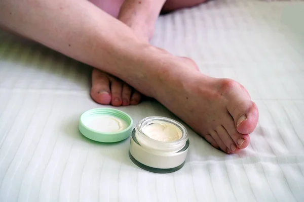 female legs with problem with women's feet and cream cosmetic, bunion toes in bare feet. Hallus valgus, closeup