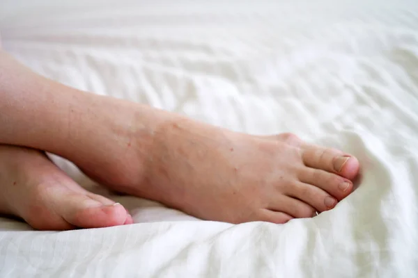 female legs with problem with women\'s feet, bunion toes in bare feet. Hallus valgus, closeup
