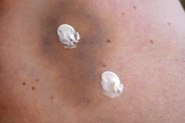 Uma Mulher Aplica Creme Cura Hematoma Perna Tratar Uma Nódoa — Fotografia de Stock