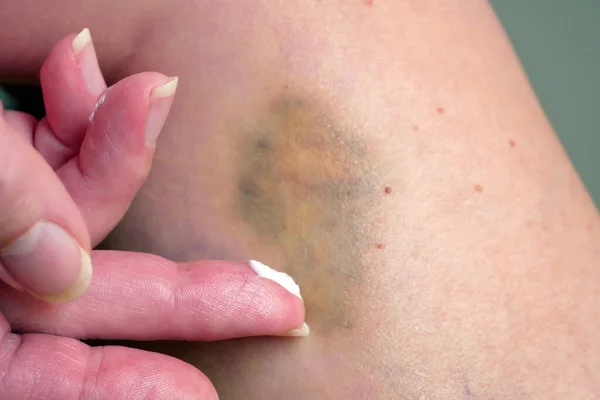 Woman Applies Healing Cream Bruise Leg Treating Bruise Home Varicose — Stock Photo, Image