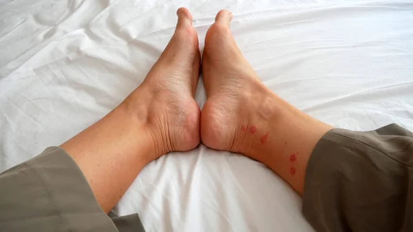 mosquito bites ticks on woman's legs, Lyme disease, closeup