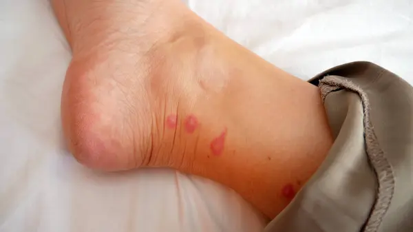 mosquito bites ticks on woman\'s legs, Lyme disease, closeup