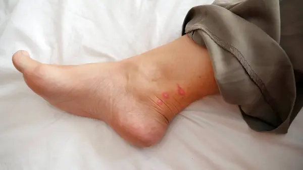 mosquito bites ticks on woman\'s legs, Lyme disease, closeup
