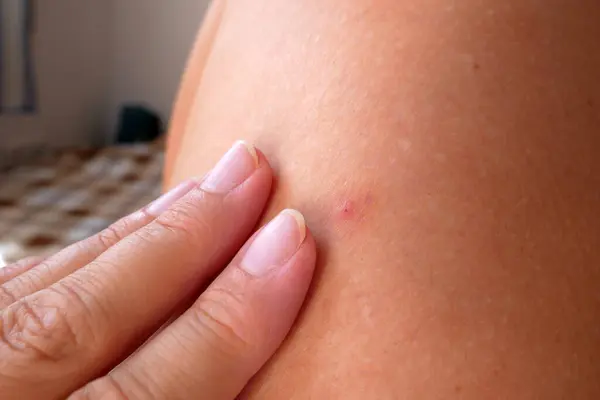 Komar Gryzie Kleszcze Kobiecych Nogach Borelioza Zbliżenie — Zdjęcie stockowe