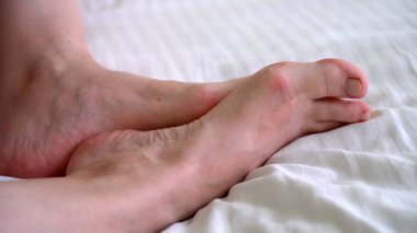 Kadın bacakları, kadın ayakları, ayak parmakları, çıplak ayaklar. Hallus Valgus, yakın plan.