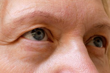 Orta yaşlı kadın yüzü ve sarkık göz kapakları. Ptosis, göz kapağının üst kısmının sarkmasıdır. Göz tembelliği, ilk kırışıklıklar, yakın çekim.
