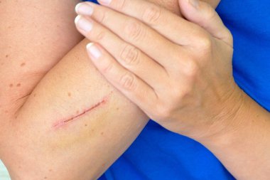 Scar 'ın elindeki derin kesiği tedavi ediyor. Deride kesik ve yara, yakın plan.