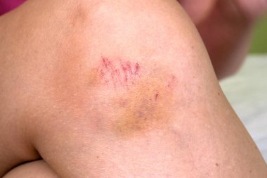 Kadın bacağında büyük çürükler var. Tedavi, kapalı alanda.