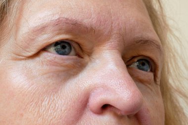 Orta yaşlı kadın yüzü ve sarkık göz kapakları. Ptosis, göz kapağının üst kısmının sarkmasıdır. Göz tembelliği, ilk kırışıklıklar. Yakın çekim.