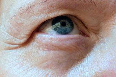 Orta yaşlı kadın yüzü ve sarkık göz kapakları. Ptosis, göz kapağının üst kısmının sarkmasıdır. Göz tembelliği, ilk kırışıklıklar, yakın çekim.