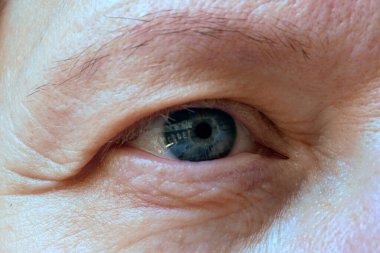 Orta yaşlı kadın yüzü ve sarkık göz kapakları. Ptosis, göz kapağının üst kısmının sarkmasıdır. Göz tembelliği, ilk kırışıklıklar, yakın çekim.
