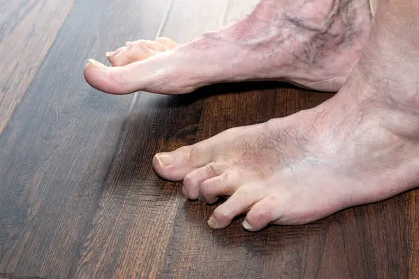 男子畸形的锤托显示左脚一年后的手术显示多种情况 包括脚趾头真菌病和静脉炎 免版税图库图片