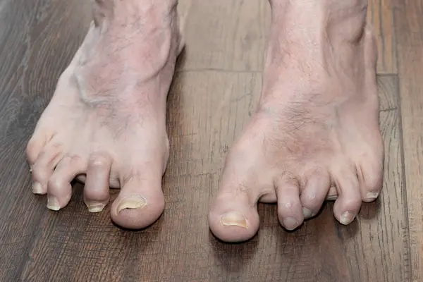 男子畸形的锤托显示左脚一年后的手术显示多种情况 包括脚趾头真菌病和静脉炎 图库图片