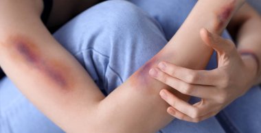 Çürük kollu genç kadın, yakın plan.