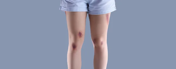 Gri Arka Planda Yaralı Bacakları Olan Genç Bir Kadın — Stok fotoğraf