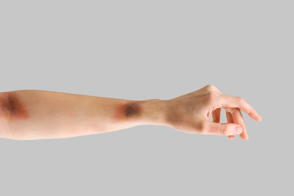 Blåslagen Kvinnlig Hand Grå Bakgrund — Stockfoto